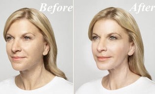 Before and after using the Goji Cream
