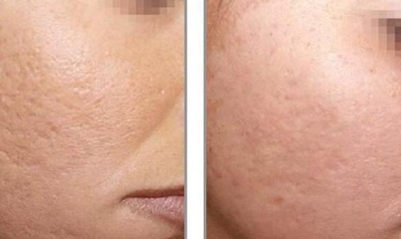 photo before and after laser resurfacing