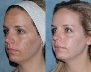 Before and after photos of the fractions of facial rejuvenation
