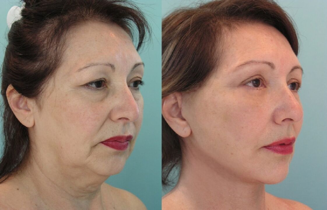 Before and after facelift with thread