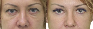 Before and after photos of the eyelid contour