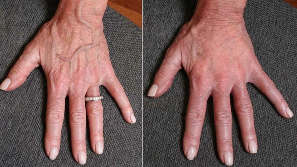 plastic contour, hand rejuvenation photo 1 before and after