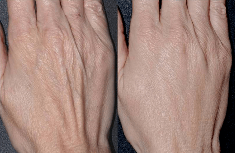 plastic contour, hand rejuvenation photo 2 before and after
